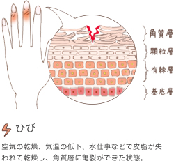 ひび　空気の乾燥、気温の低下、水仕事などで皮脂が失われて乾燥し、角質層に亀裂ができた状態。