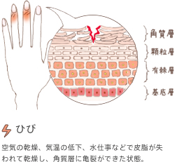 ひび　空気の乾燥、気温の低下、水仕事などで皮脂が失われて乾燥し、角質層に亀裂ができた状態。