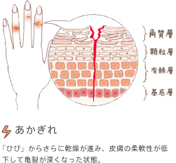 あかぎれ　「ひび」からさらに乾燥が進み、皮膚の柔軟性が低下して亀裂が深くなった状態。