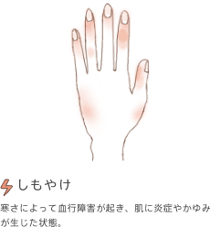 しもやけ　激しい気温の変化で血管の収縮により血行障害が起き、炎症やかゆみが生じた状態。