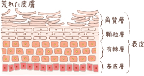 荒れた皮膚