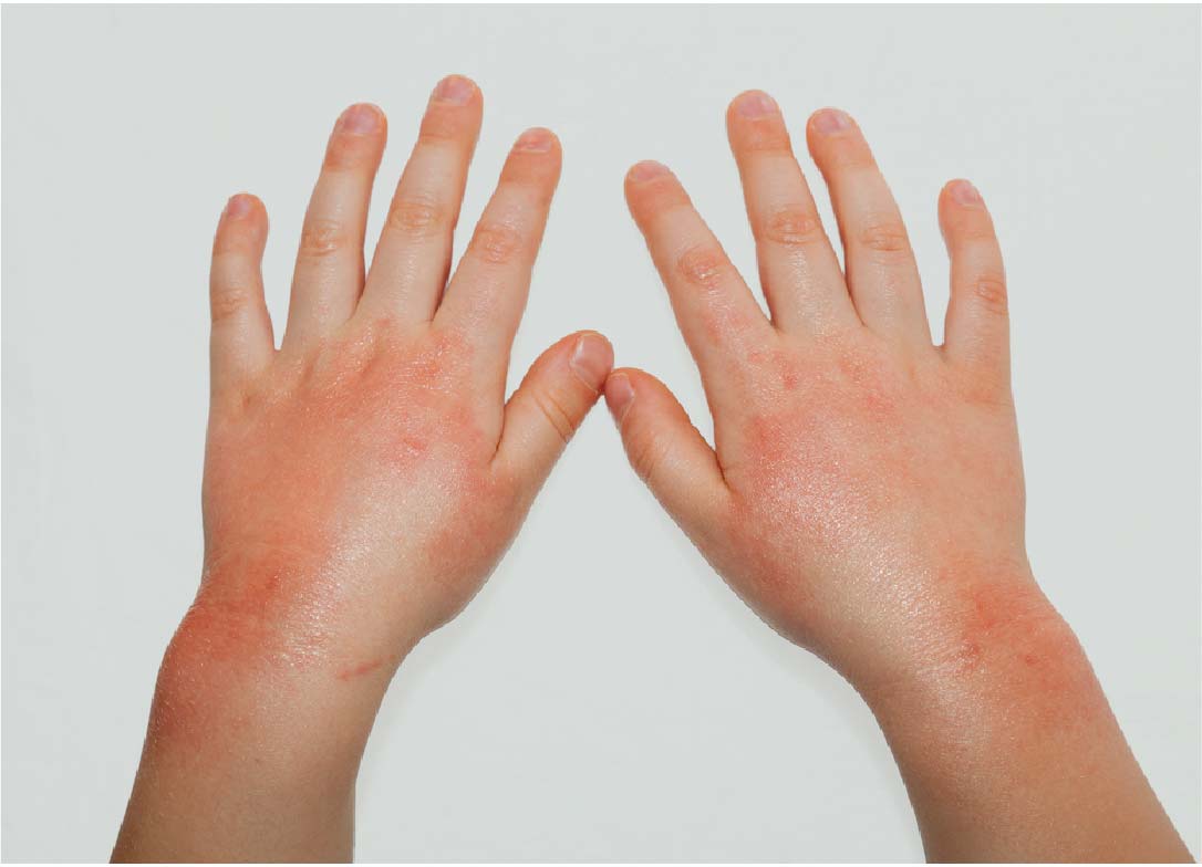 寒い日に手が真っ赤に 子供の しもやけ への対処法 肌育研究所