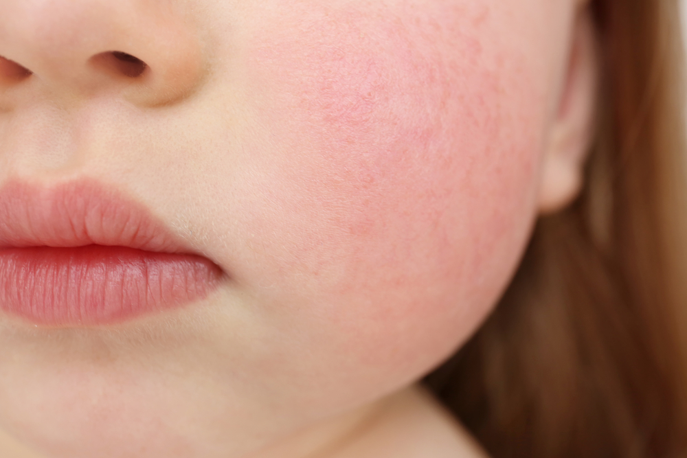 子供の肌トラブル 顔に赤みが出る原因は乾燥 対処法をご紹介 肌育研究所