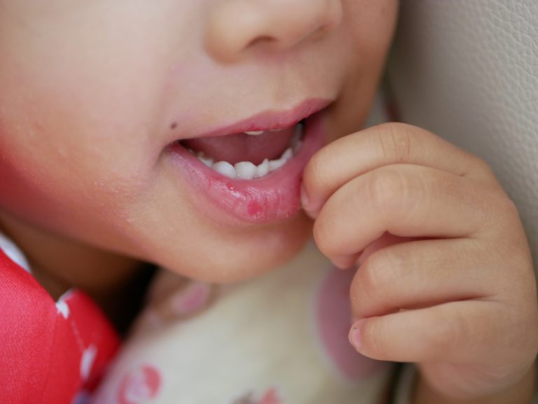 原因は乾燥肌 子供の皮膚や唇の皮がポロポロむけるときの対処法 肌育研究所