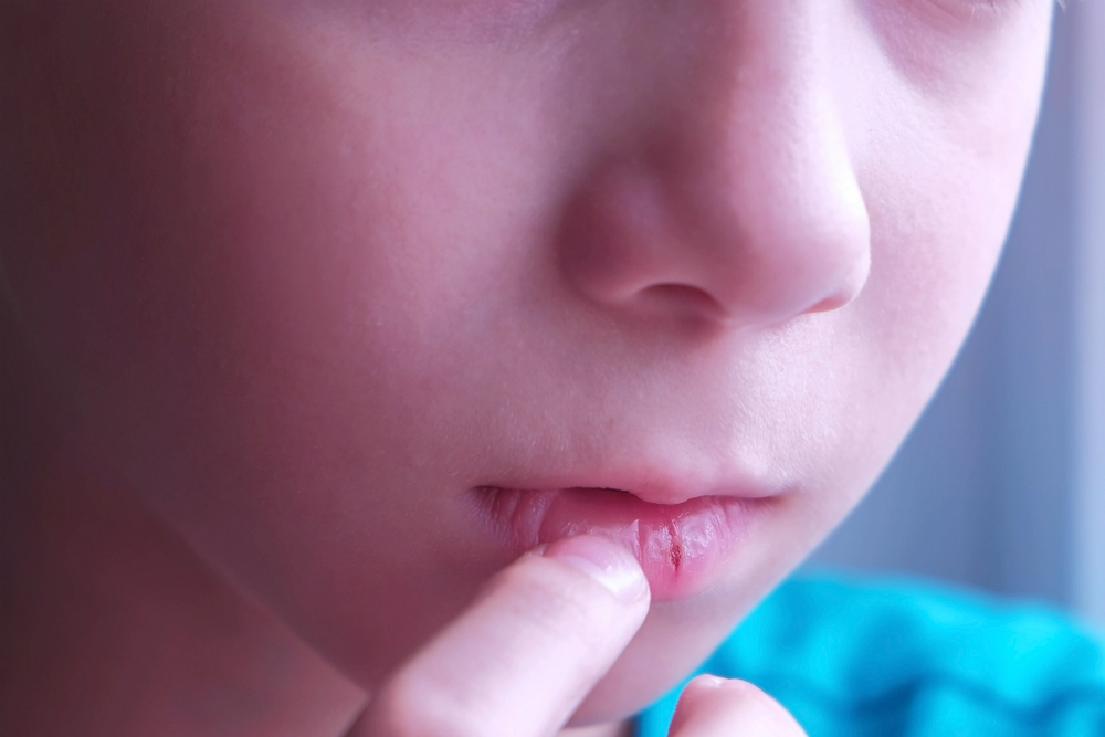 原因は乾燥肌 子供の皮膚や唇の皮がポロポロむけるときの対処法 肌育研究所